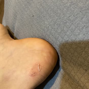 Bershka Ayakkabı Ayağımı Yara Yaptı