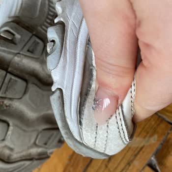 7 Ayda Yırtılan Sketchers Ayakkabı Sorunu