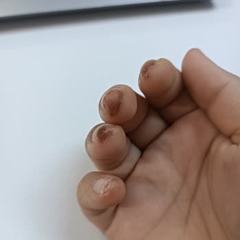 Aymira Koçaklı Yaşam Merkezi Parmaklarımı Yaktı