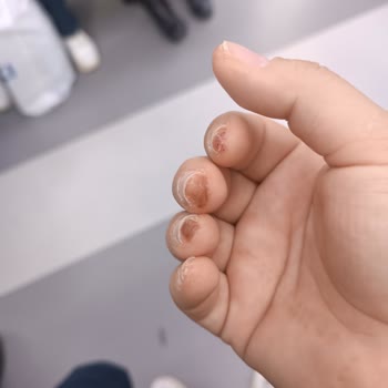 Aymira Koçaklı Yaşam Merkezi Parmaklarımı Yaktı