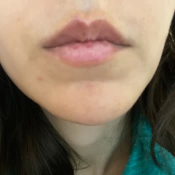 Şeyda Zaloğlu Beauty Dudak Dolgusu Etkisinin Kısa Sürede Kaybolması