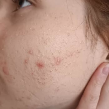 Evkur Alışveriş Duaderm Ürünleri Cildimi Kötü Etkiledi