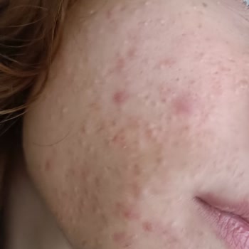 Evkur Alışveriş Duaderm Ürünleri Cildimi Kötü Etkiledi