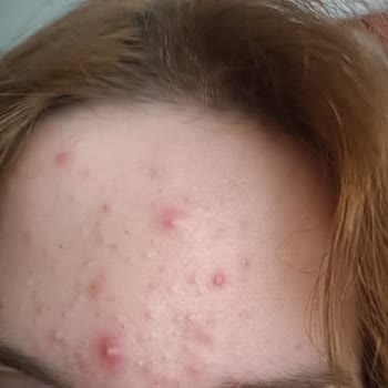 Evkur Alışveriş Duaderm Ürünleri Cildimi Kötü Etkiledi