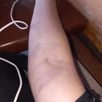 Biga Devlet Hastanesi Kan Almayı Bilmeyen Hemşireler