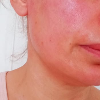 Loreal Paris Yüz Kremi Alerjisi