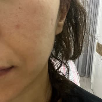 Day2day Collagen Sivilce Ve Kaşıntı Yaptı