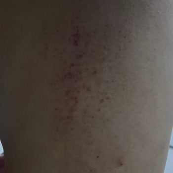 Day2day Collagen Sivilce Ve Kaşıntı Yaptı