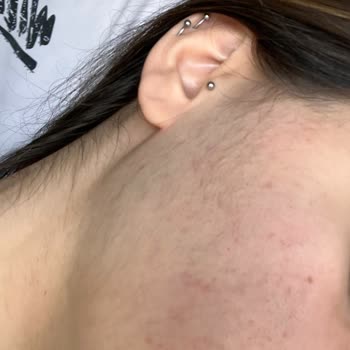 Novar Poliklinik Lazer Epilasyon Sonucu Fazla Tüylenme Yaşadım