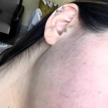 Novar Poliklinik Lazer Epilasyon Sonucu Fazla Tüylenme Yaşadım