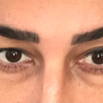 Novar Poliklinik Göz Altı Işık Dolgusu