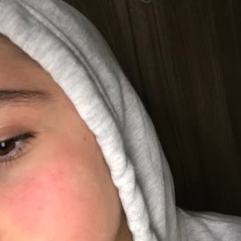 Claderm Kil Maskesi Yüzümü Yaktı Ve Kızarttı