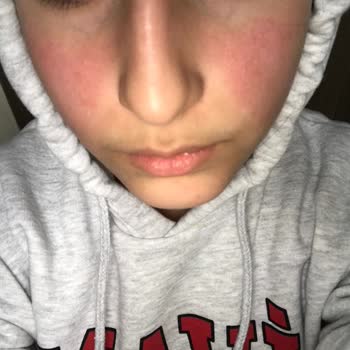 Claderm Kil Maskesi Yüzümü Yaktı Ve Kızarttı