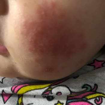 Sağlık Bakanlığı Uyuz Hastalığının Görmezden Gelinmesi