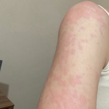 The Purest Solutions Ciltte Alerji The Purest Kırmızı Peeling