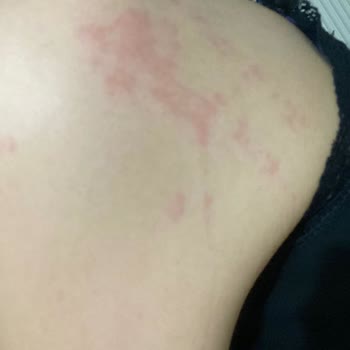 The Purest Solutions Ciltte Alerji The Purest Kırmızı Peeling