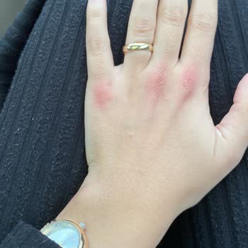 The Purest Solutions Ciltte Alerji The Purest Kırmızı Peeling