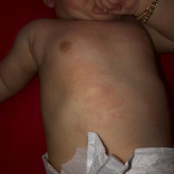 Mustela Kızarıklık Ve Döküntü