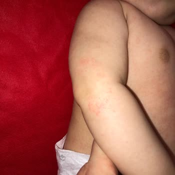 Mustela Kızarıklık Ve Döküntü