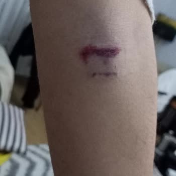 Birinci International Hastanesi Kan Alan Hemşire