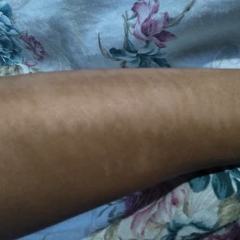 Sandra Güzellik ve Epilasyon Salonu Kollarımı Yakması İzlerin Kalması