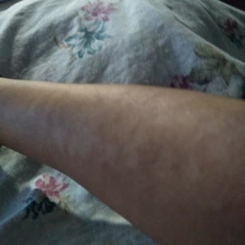 Sandra Güzellik ve Epilasyon Salonu Kollarımı Yakması İzlerin Kalması