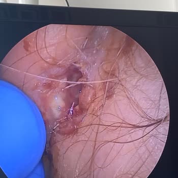 Op. Dr. Mehmet Sucubaşı Kepçe Kulak Ameliyatı