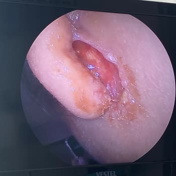 Op. Dr. Mehmet Sucubaşı Kepçe Kulak Ameliyatı