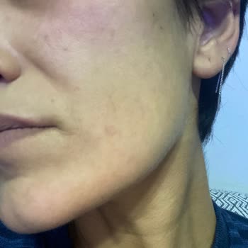 Garnier Ciltte Tahriş Ve Kabarma