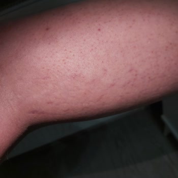 Aris Güzellik Merkezleri Lazer Epilasyondan Yanma