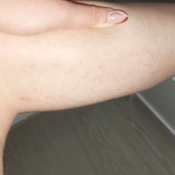 Aris Güzellik Merkezleri Lazer Epilasyondan Yanma