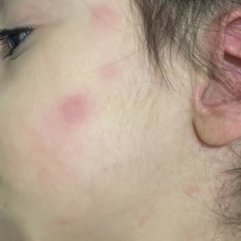 Enterogermina Çocuğum Alerji Yaptı: İlaç Yan Etkileri