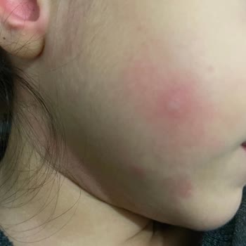 Enterogermina Çocuğum Alerji Yaptı: İlaç Yan Etkileri