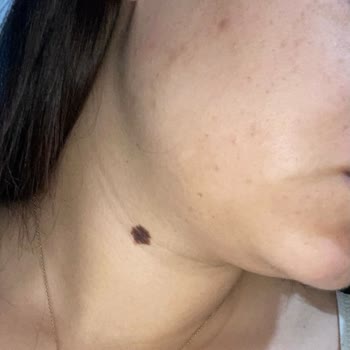 The Purest Solutions Sivilce Çıkardı