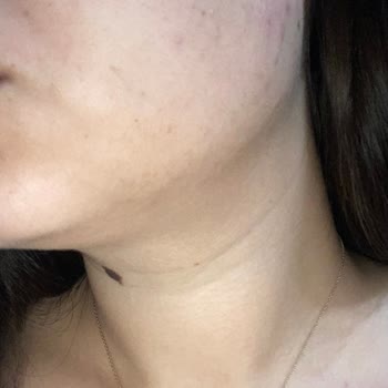 The Purest Solutions Sivilce Çıkardı