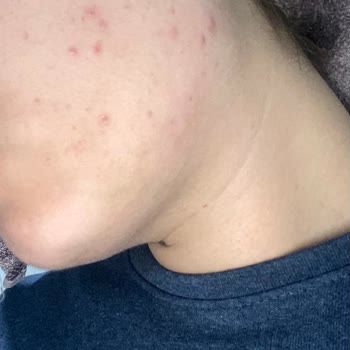 The Purest Solutions Sivilce Çıkardı