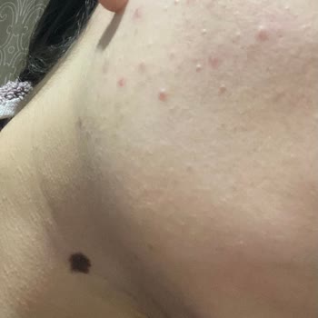 The Purest Solutions Sivilce Çıkardı