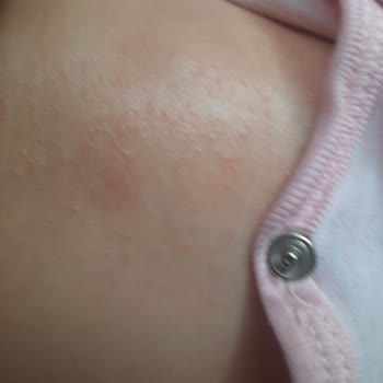 Mustela Bebek Kreminin Alerji Ve Egzama Problemi