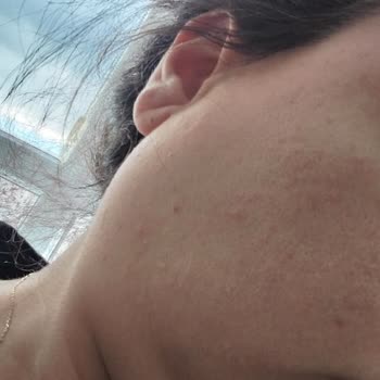 Yves Rocher Tonik Yüzümü Kötü Yaptı