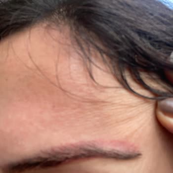 Neslim Güngen Güzellik Kaş Silme Sonrası Yanık Gibi Kızarıklık!