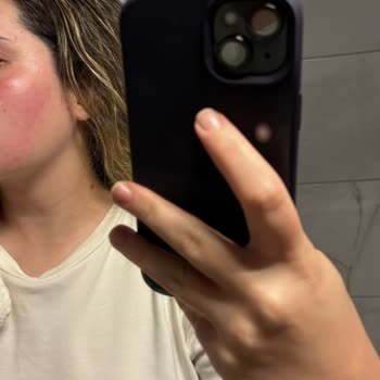 The Purest Solutions The Purest Kırmızı Serum Cildimi Yaktı