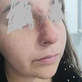 Larissa Clinic Hatalı Uygulama Sonucu Doku Ölümü Yaşıyorum!