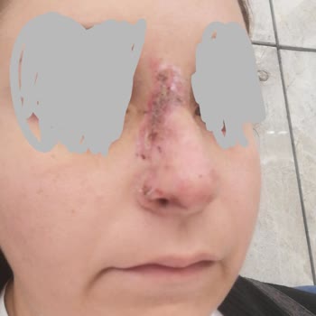 Larissa Clinic Hatalı Uygulama Sonucu Doku Ölümü Yaşıyorum!