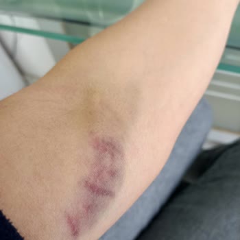 Sağlık Bakanlığı Sağlık Personeli Kolumu Morarttı