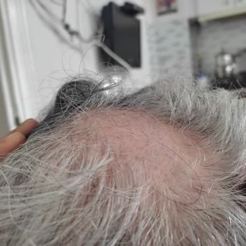 Esteticium Güzellik Merkezi Esteticium Saç Ekimi