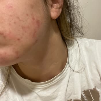 The Purest Solutions Yüzümde Yanma Ve Kaşıntı