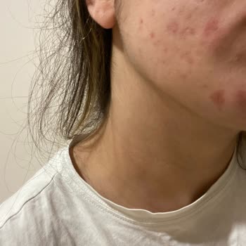 The Purest Solutions Yüzümde Yanma Ve Kaşıntı