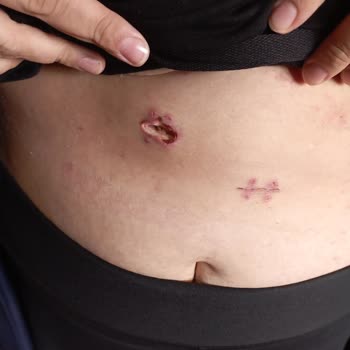 Kayseri Şehir Hastanesi Hastane Personel Yetersizliği