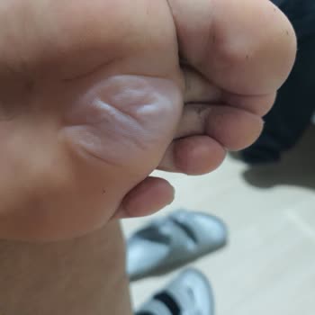 Puma Ayakkabı Ayak Rahatsızlığı