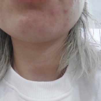 The Purest Solutions The Purest Ürünleri Cildimi Mahvetti